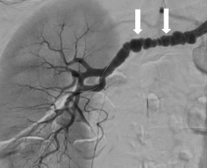 Fmd And Reconstruction What You Need To Know Before Surgery - sa500u6
